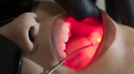 Lesões na boca por causa da quimioterapia já têm solução